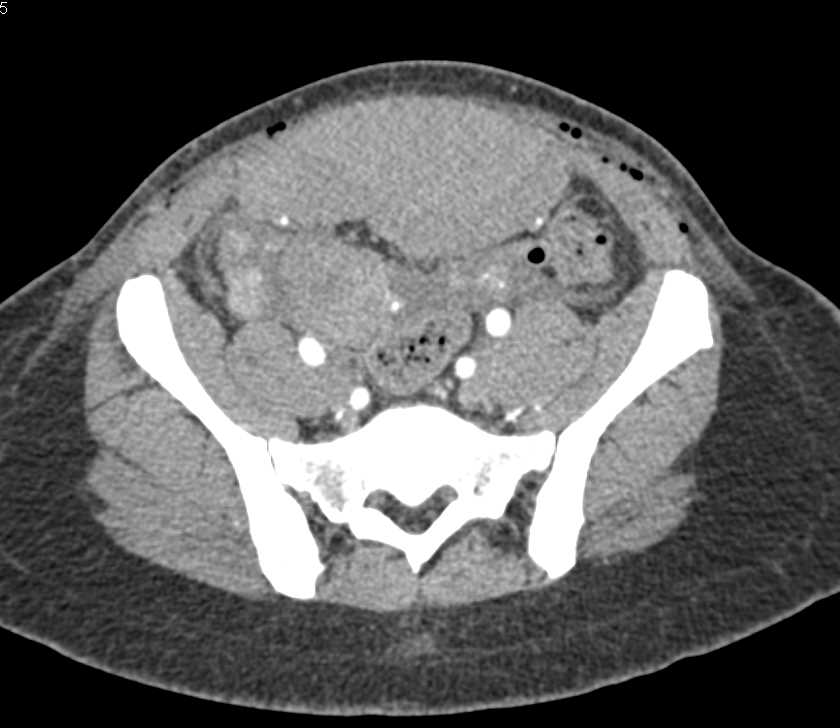 Post-Op Rectus Hematoma - CTisus CT Scan