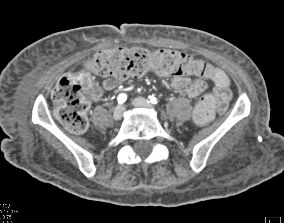 Left Sacroiliitis with Inflammation Beyond Sacroiliac Joint (SI Joint) - CTisus CT Scan