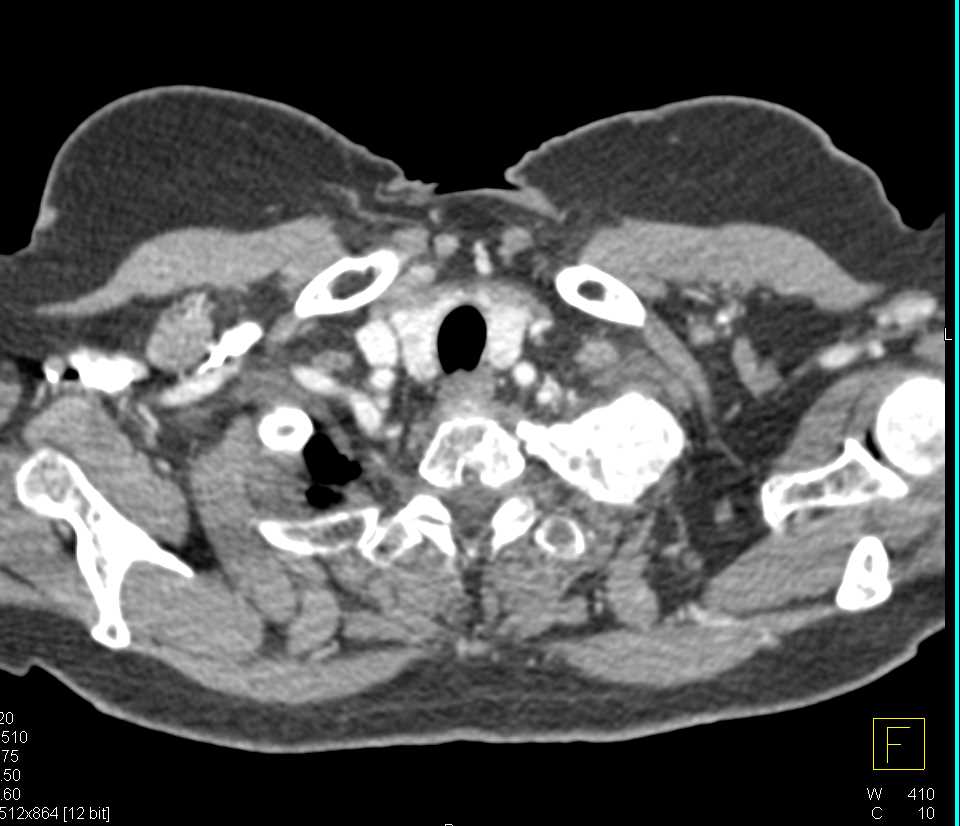 Blastic Metastases to Left First Rib and Spine due to Lung Cancer - CTisus CT Scan