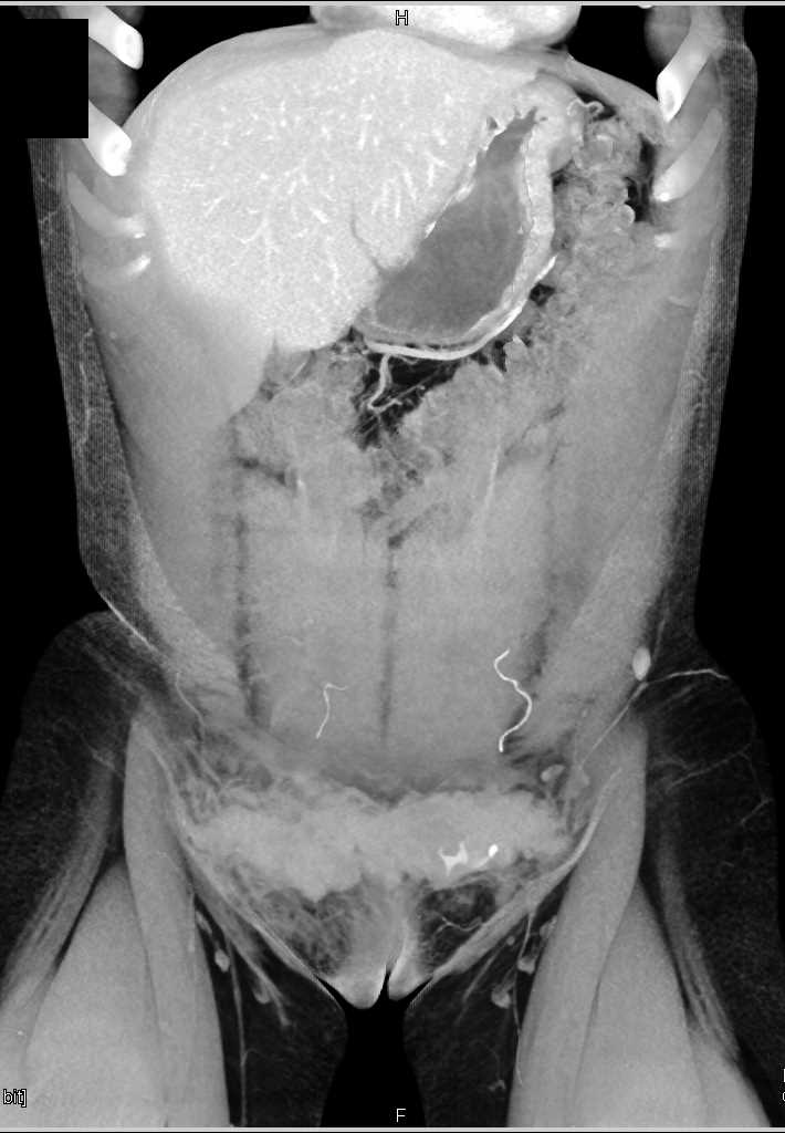 Hematoma in the Subcutaneous Tissues Abdominal Wall - CTisus CT Scan