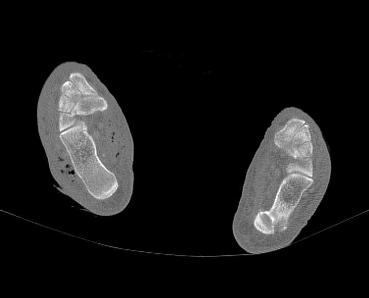 Abscess in Heel Following Puncture Wound - CTisus CT Scan