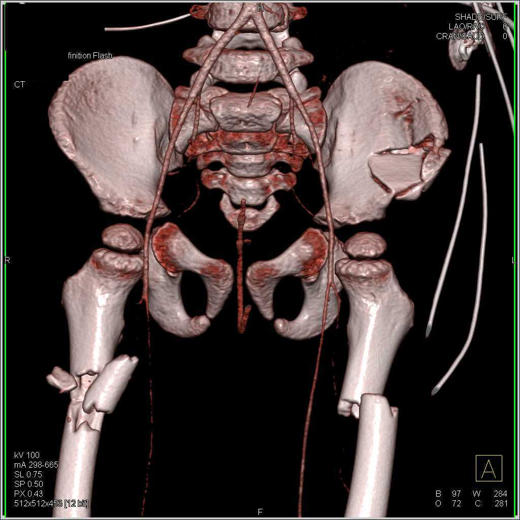 Bilateral Femur Fractures Following an Motor Vehicle Accident (MVA) - CTisus CT Scan