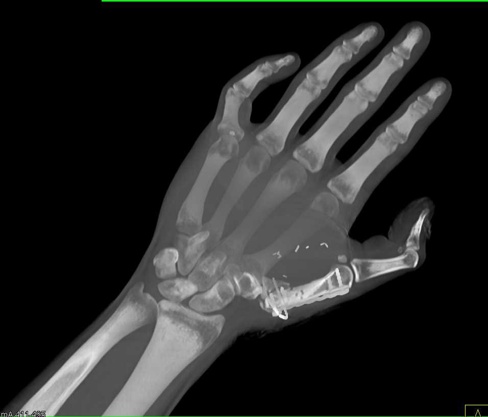 CTA Hand with Post Op Changes - CTisus CT Scan