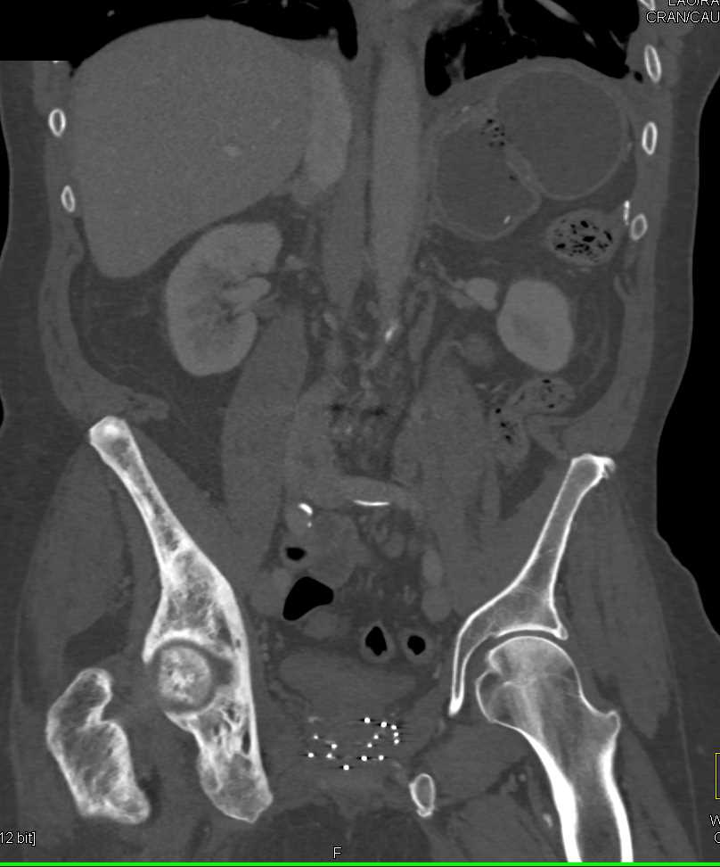 Paget's Disease Right Hemipelvis - CTisus CT Scan