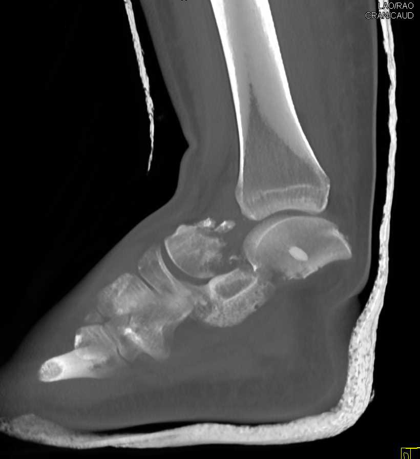 talus fracture orthobullets
