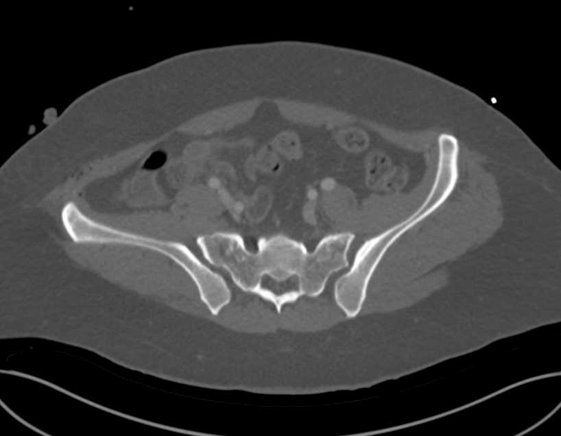 Extensive Pelvic Fractures Also Involve the Sacroiliac Joints (SI Joints) - CTisus CT Scan