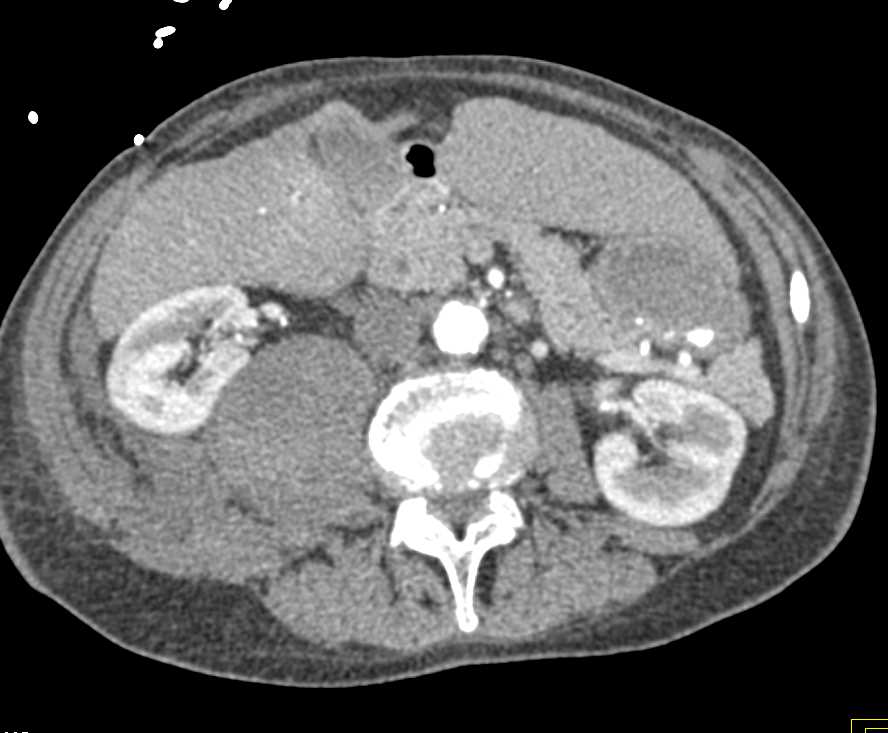 Active Bleed Right Psoas Muscle - CTisus CT Scan