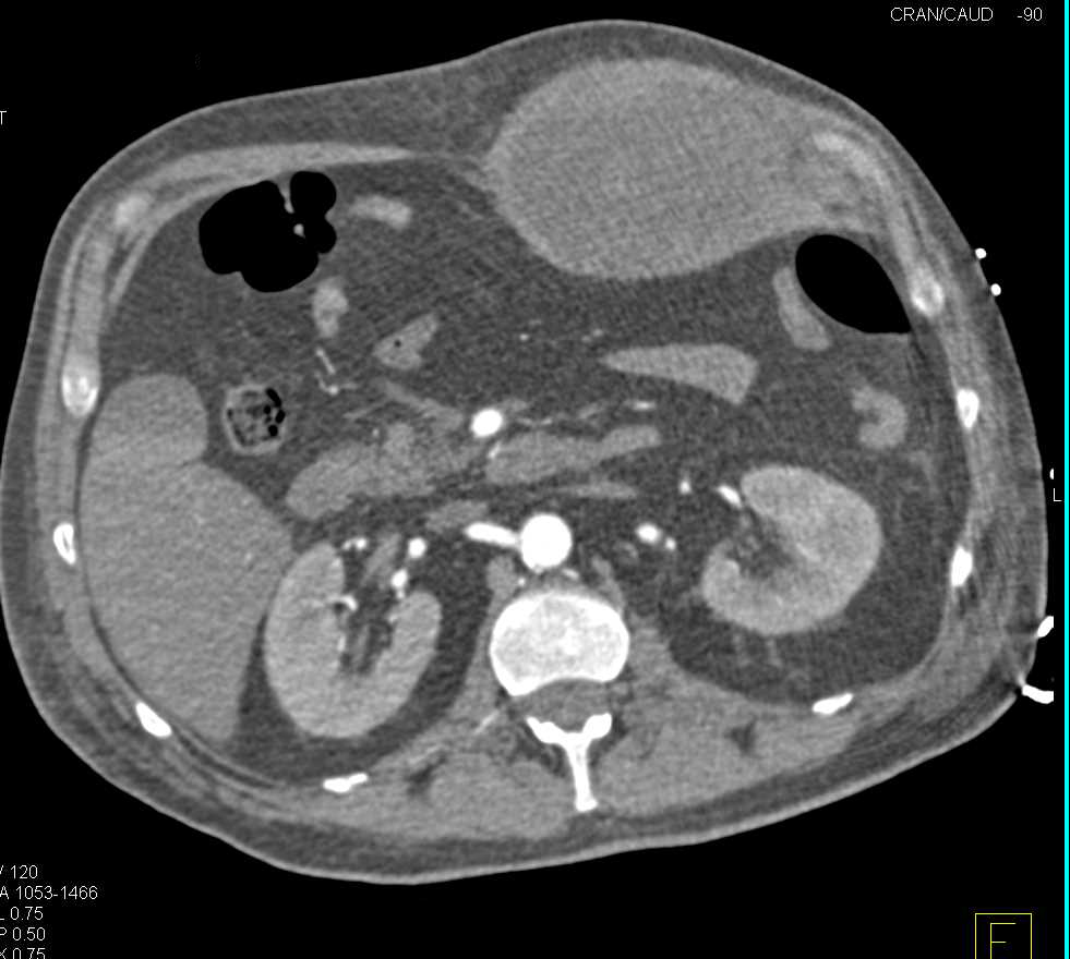 Left Rectus Hematoma - CTisus CT Scan