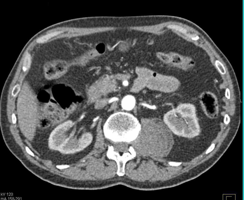 Classic Neurofibroma on Multiple View - CTisus CT Scan