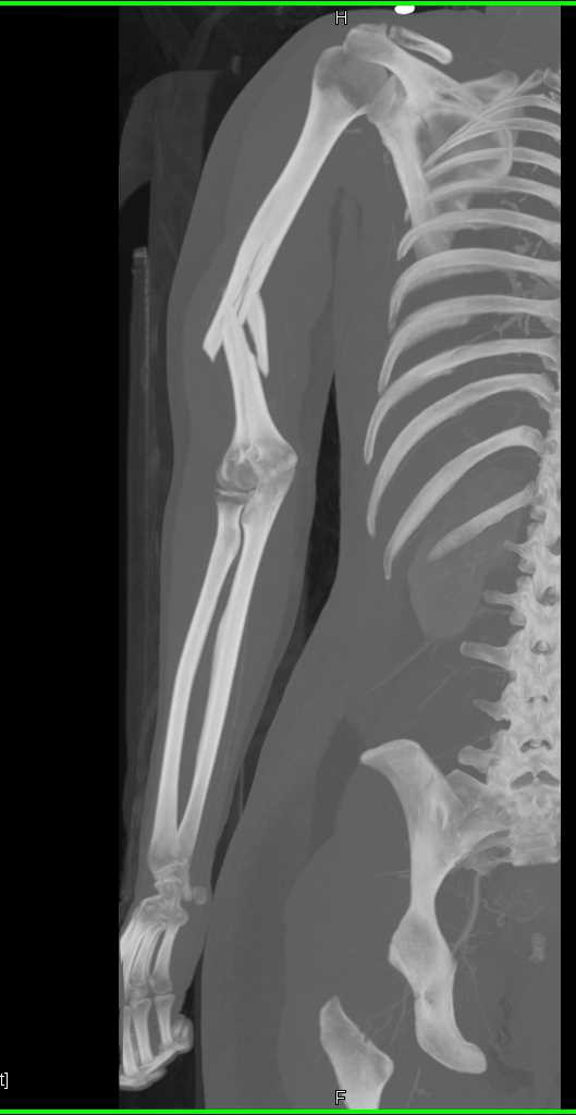 Angulated Humerus Fracture Without Vascular Injury - CTisus CT Scan