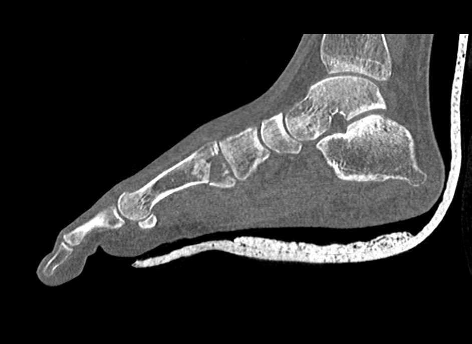 Fracture of the Base of the First Metatarsal - CTisus CT Scan