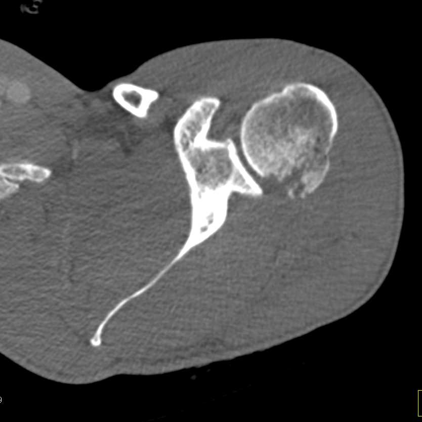 Fracture of Acromion and Humerus Due to GSW - Musculoskeletal Case ...