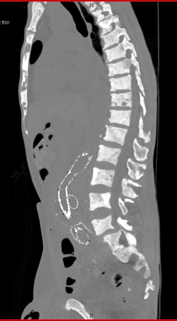 Blastic Metastases from Breast Cancer to Bone - CTisus CT Scan