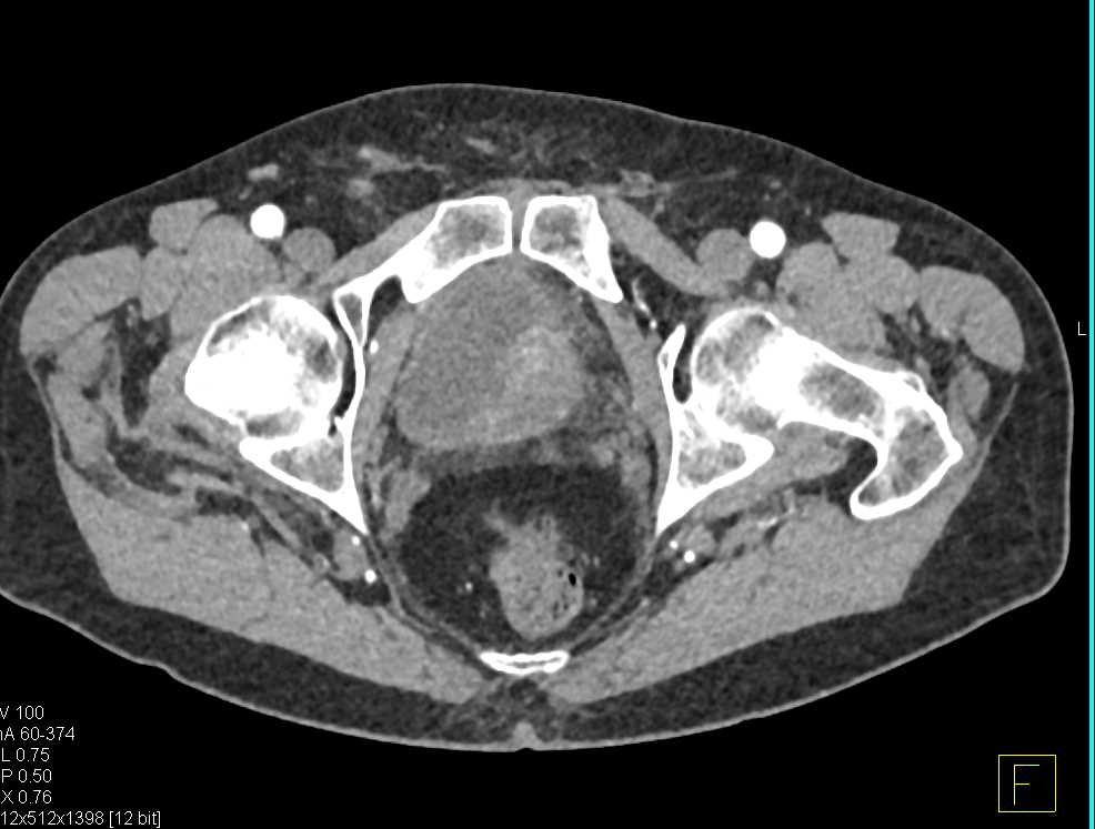 Bladder Cancer and Insufficiency Fractures Sacrum - CTisus CT Scan