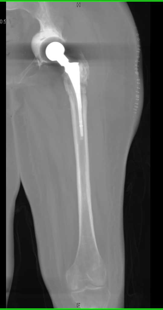 Right Total Hip Replacement - CTisus CT Scan