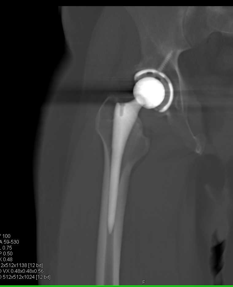 Right Total Hip Replacement - CTisus CT Scan