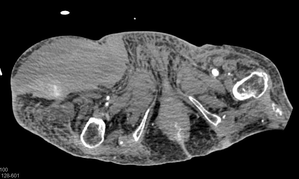 Large Hematoma Right Thigh - CTisus CT Scan