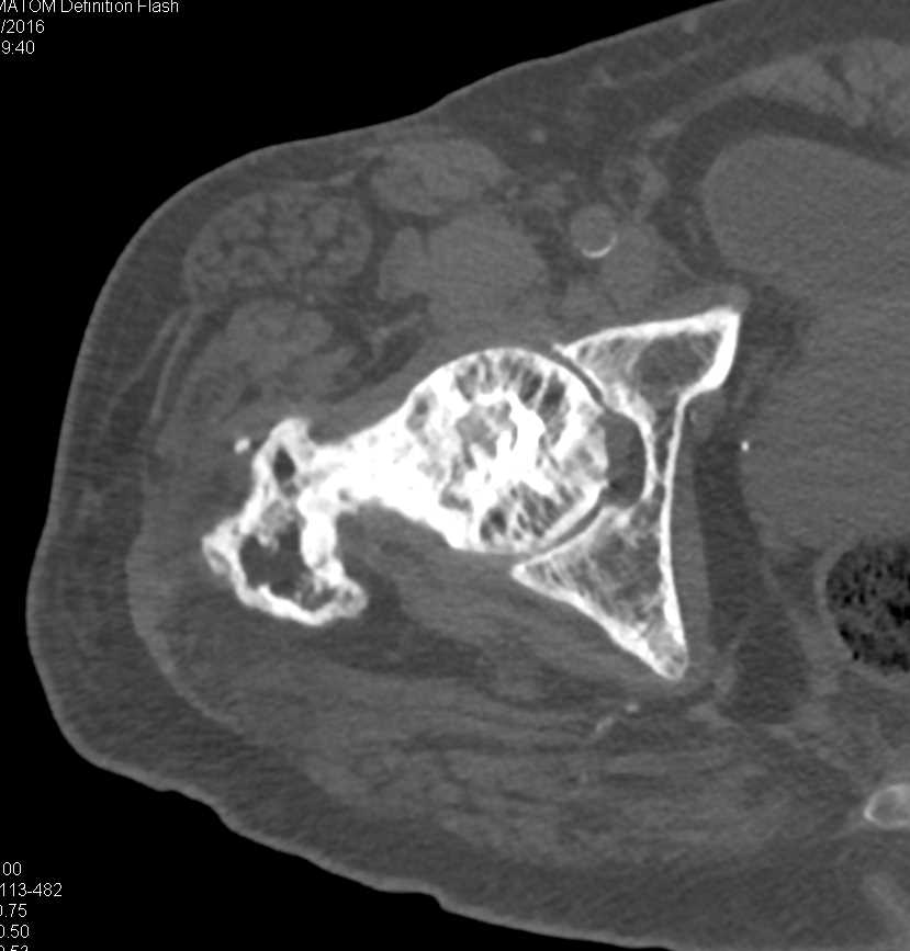 Repair of Fracture in Femur Involved with Paget's Disease - CTisus CT Scan