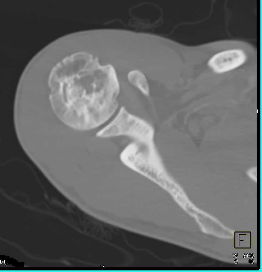 Paget's Disease Humerus - CTisus CT Scan