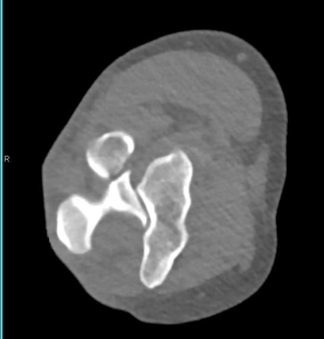 Radial Fracture and Elbow Dislocation - CTisus CT Scan