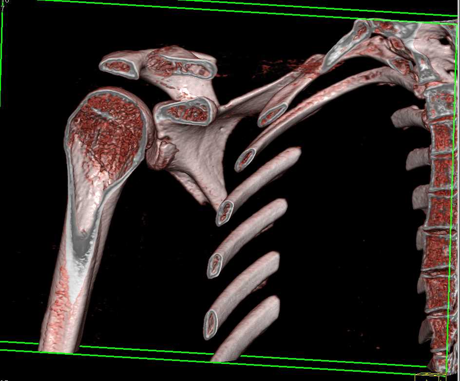 Glenoid Fracture - CTisus CT Scan