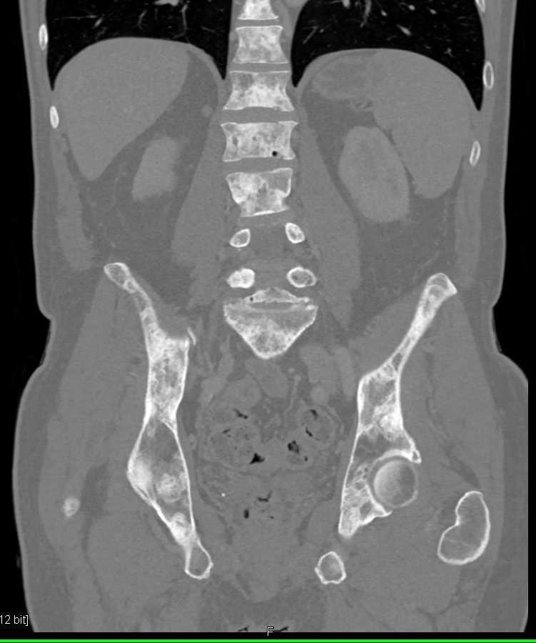 Blastic Bone Metastases to the Spine from Neuroendocrine Tumor - CTisus CT Scan