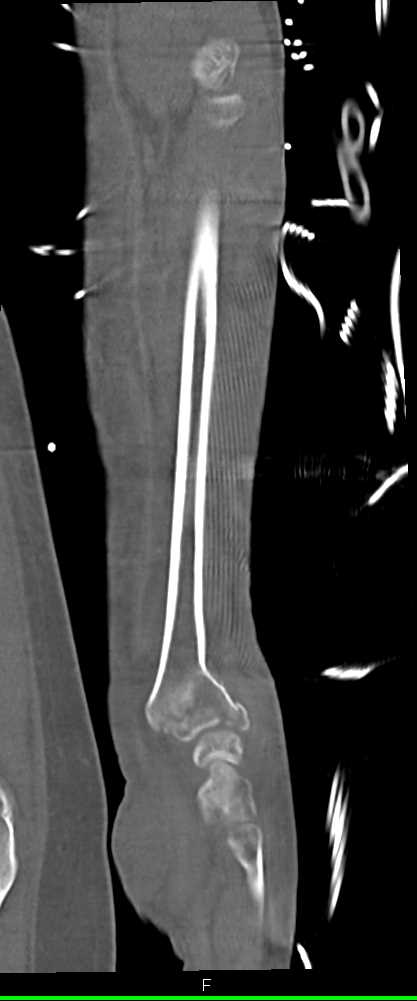 Distal Radial Fracture - CTisus CT Scan