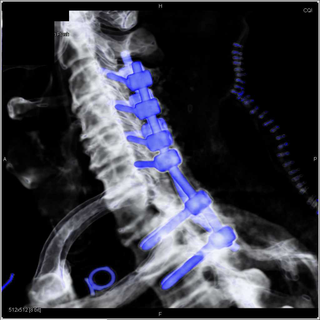 Hardware in Cervical Spine with 3D VRT - CTisus CT Scan