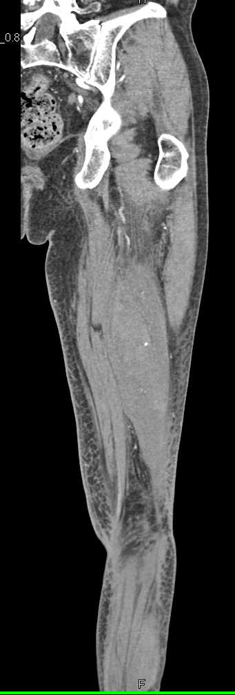 Posterior Thigh Hematoma with Active Bleed - CTisus CT Scan