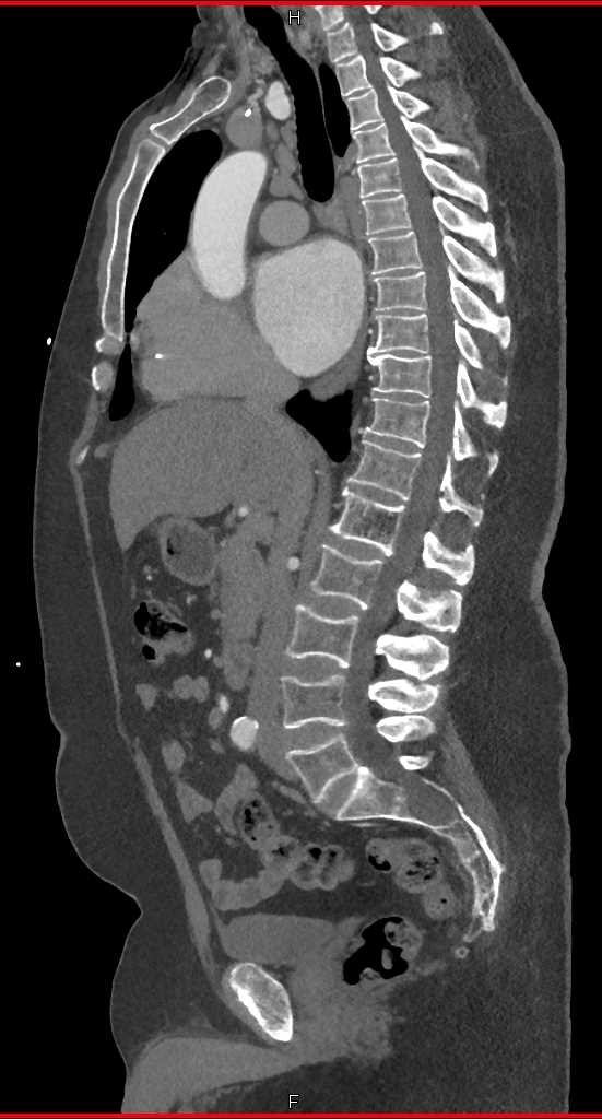 Erosion S1 by Intraspinal Neurofibroma - CTisus CT Scan