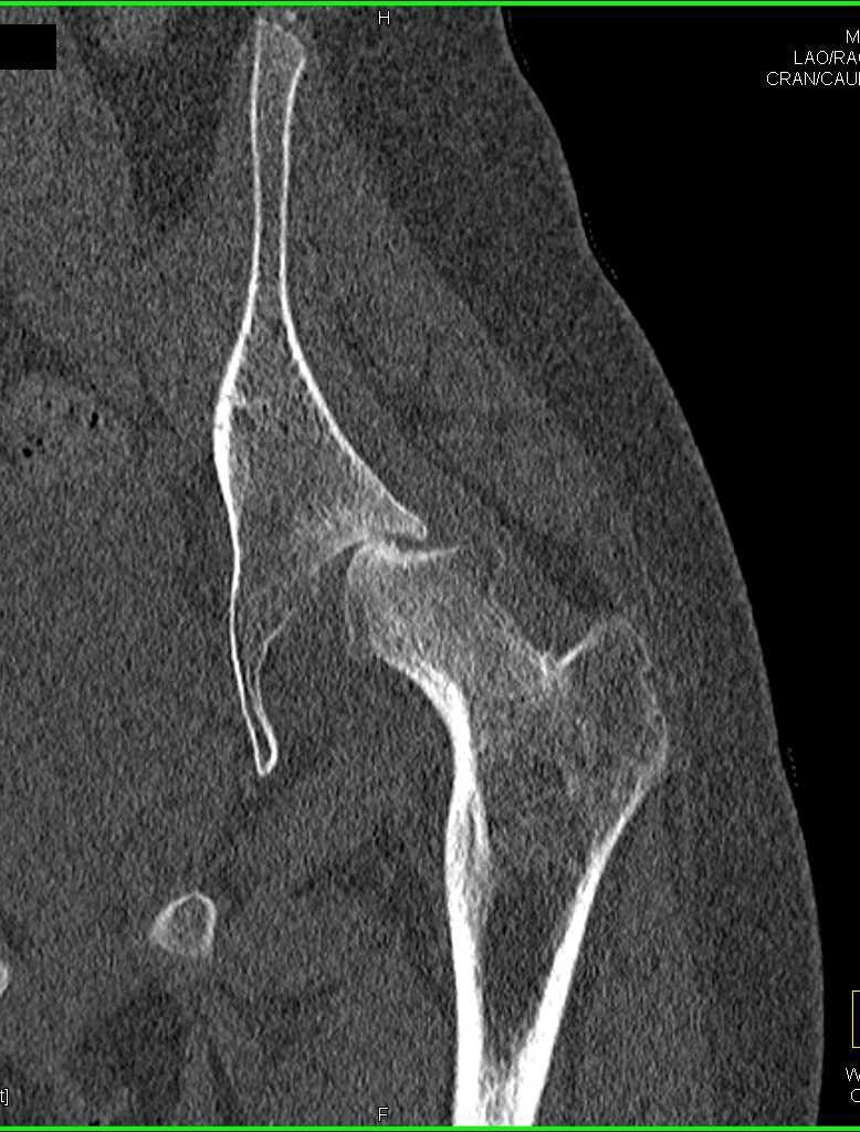 Avascular Necrosis (AVN) Left Femur - CTisus CT Scan