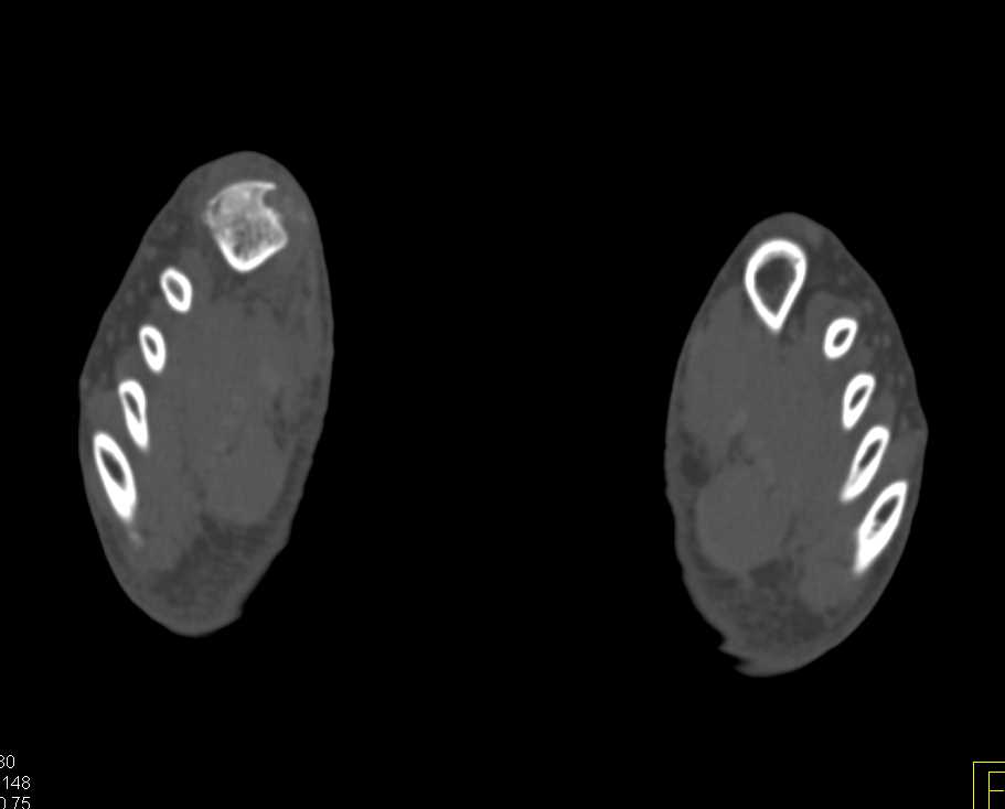 Gout Best Seen First Digit Right Foot - CTisus CT Scan