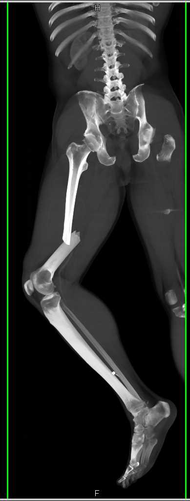 Femur Fracture Without Vascular Injury - CTisus CT Scan