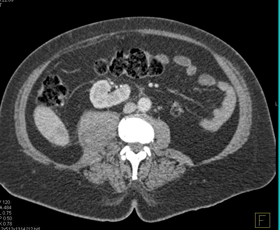 Right Iliopsoas Bleed and Spinal Fractures - CTisus CT Scan