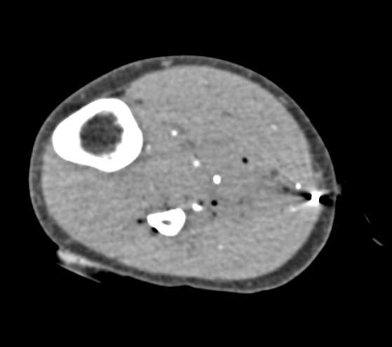 Gunshot Wound (GSW) Calf with Occlusion of the Anterior Tibial Artery - CTisus CT Scan