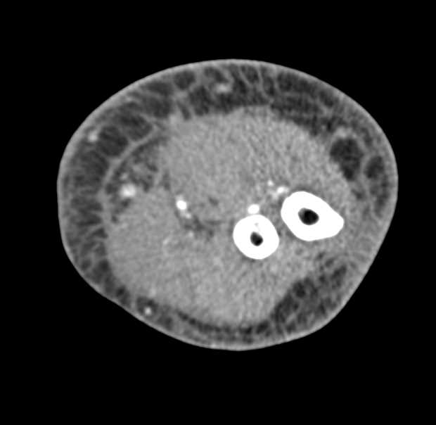 Cellulitis Left Upper Extremity - CTisus CT Scan