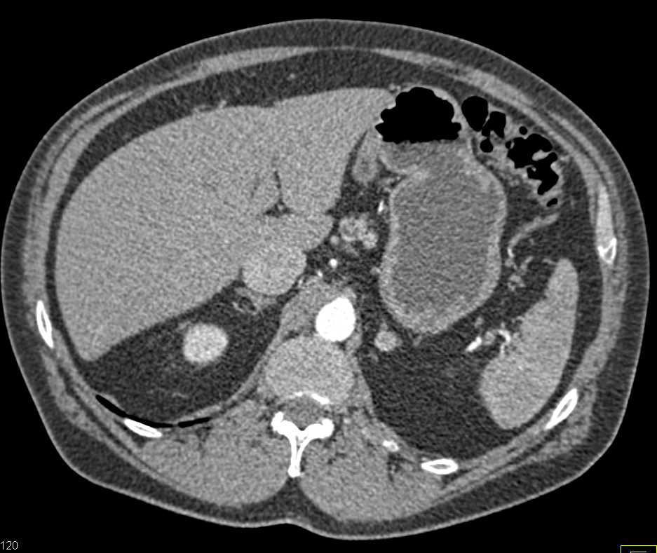 Myeloma with Multiple Lytic Lesions Including the Sacrum - CTisus CT Scan