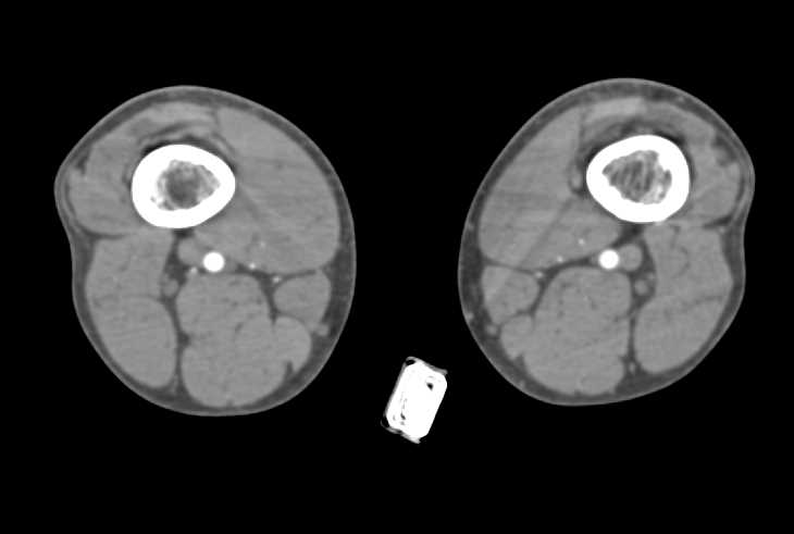 Fracture Distal Right Tibia and Fibula with Vascular Spasm - CTisus CT Scan