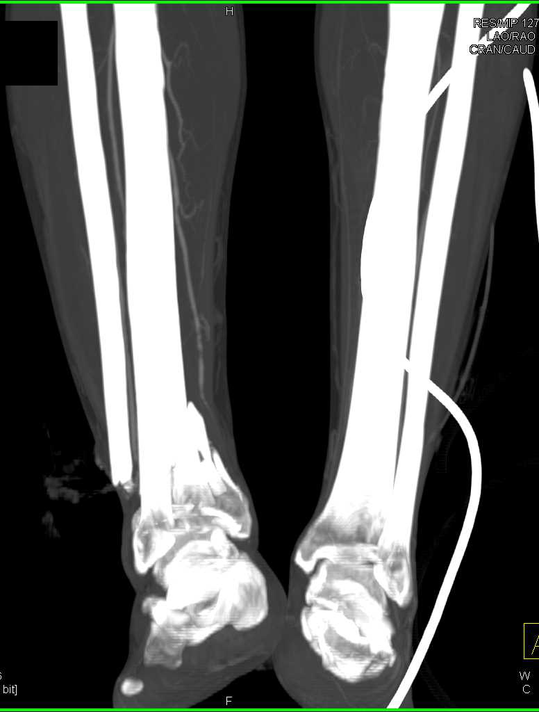 open tib fib fracture x ray