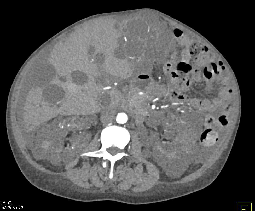 Renal Osteodystrophy with End Stage Renal Disease (ESRD) and End Stage Liver Disease (ESLD) - CTisus CT Scan