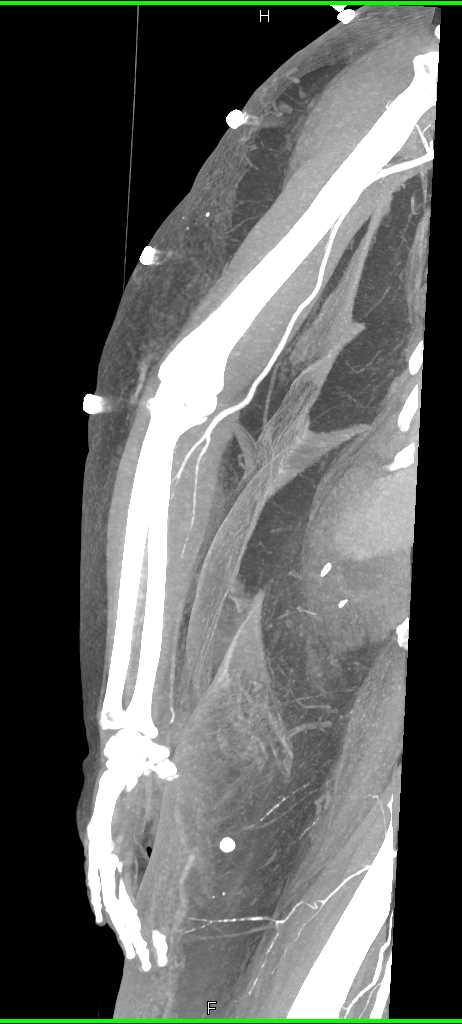 Forearm Trauma with Poor Vascular Visualizations - CTisus CT Scan