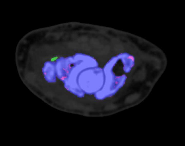 Gout Defined in Carpal Bones - CTisus CT Scan