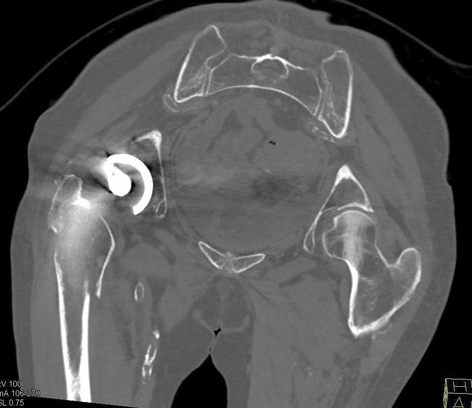 Femur Fracture and Right Total Hip Replacement - CTisus CT Scan