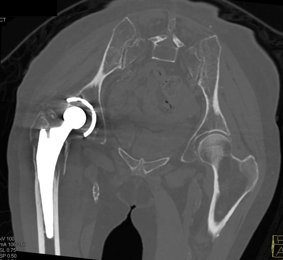 Femur Fracture And Right Total Hip Replacement Musculoskeletal Case