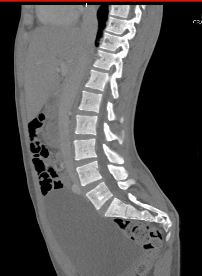 Renal Osteodystrophy - CTisus CT Scan