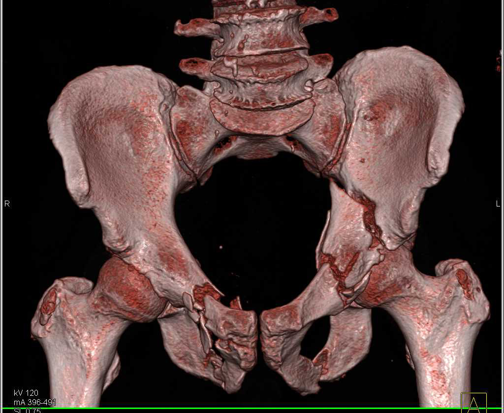 Complex Pelvic Fractures including the Left Acetabulum - CTisus CT Scan