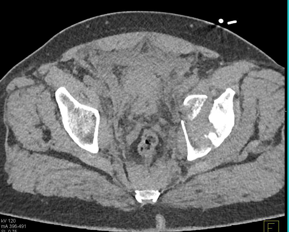 Complex Pelvic Fractures including the Left Acetabulum with Pelvic Hematoma - CTisus CT Scan