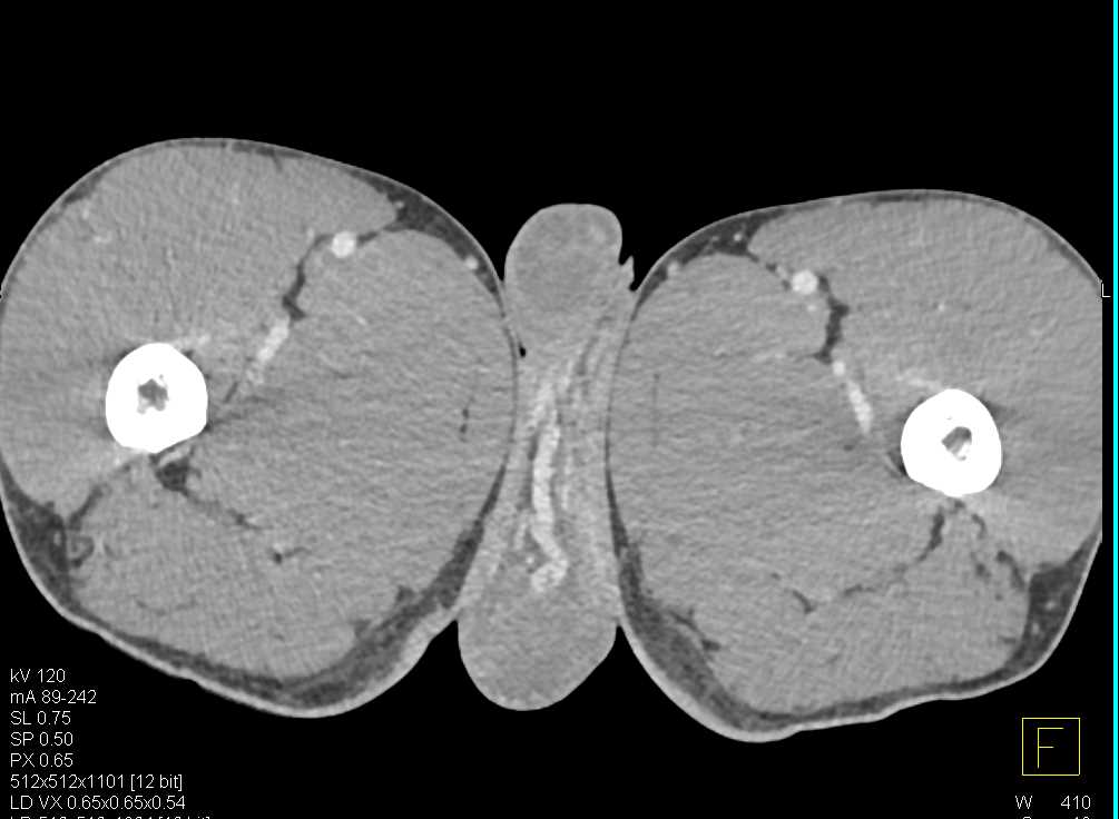 Femoral Arteries - CTisus CT Scan