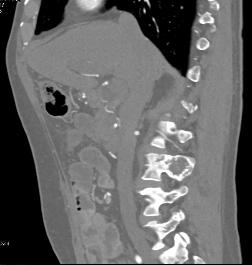 Fibrous Dysplasia Involves Ribs and the Spine - CTisus CT Scan