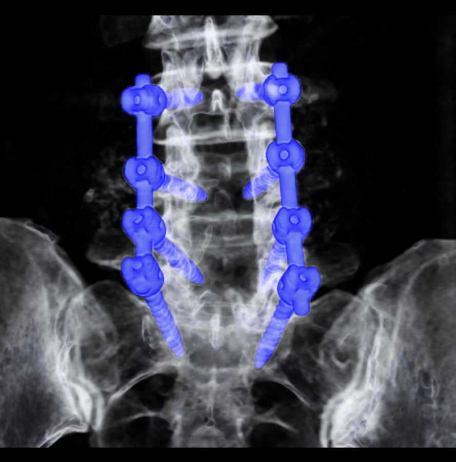 CT of L-Spine Hardware - CTisus CT Scan